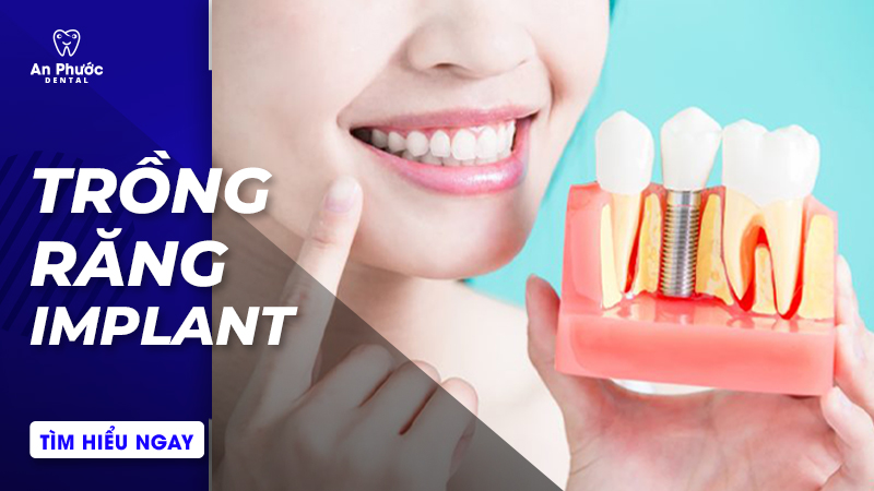 Phương pháp Implant là gì?