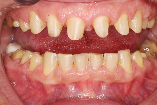 Có cần phải mài cùi răng đẹp khi bọc răng sứ?