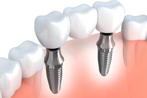 Làm thế nào để chăm sóc răng miệng sau khi cấy răng Implant?