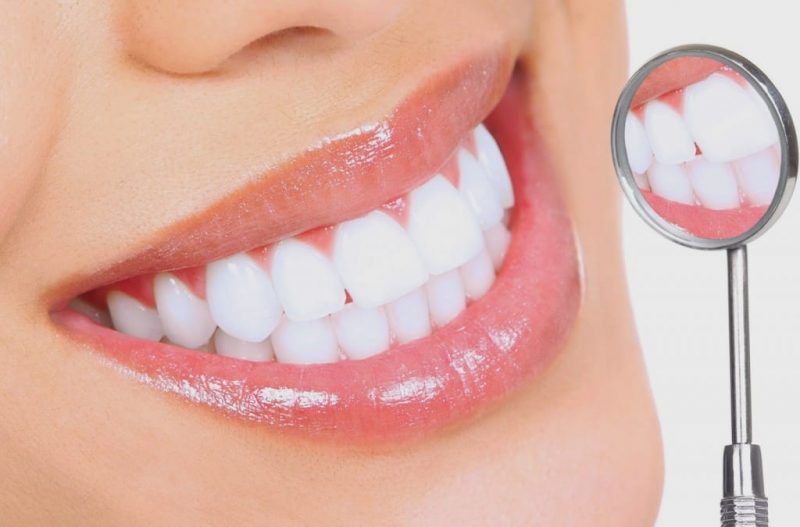 lợi ích của việc bọc răng sứ