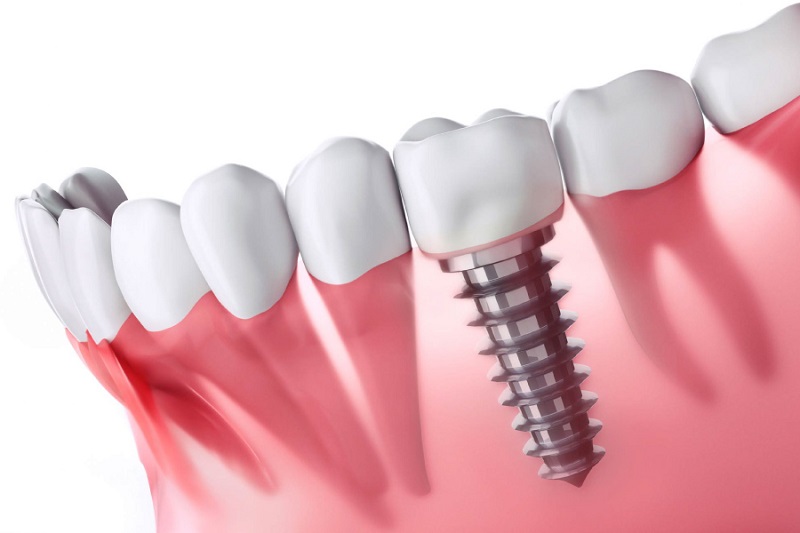 Răng implant sau khi phục hình bền đẹp trắng sáng