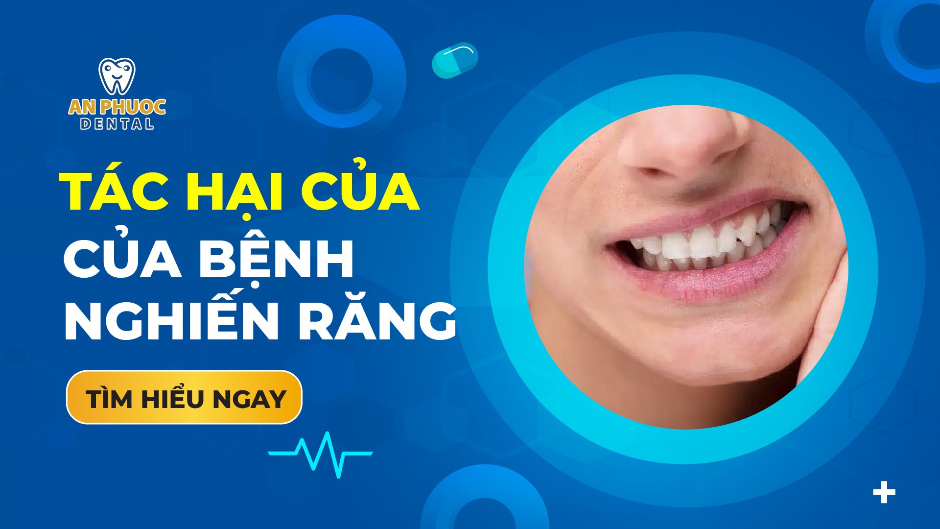 Bệnh nghiến răng là gì? Tác hại của bệnh nghiến răng z5078986568678 9e418b1f5ee2b6579bc67eea1fdff099 Tháng 10 28, 2025