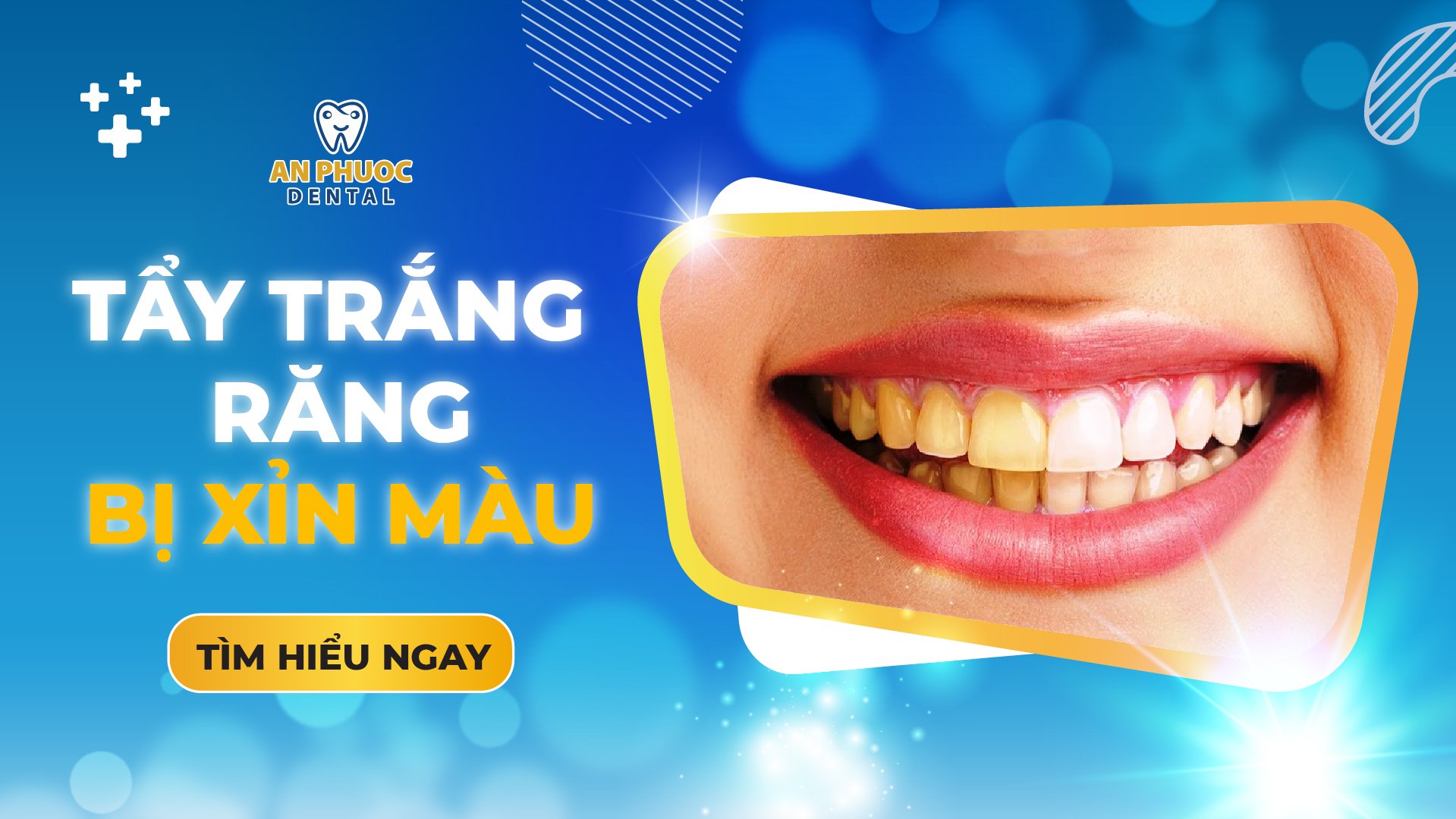 Tẩy trắng răng đối với trường hợp răng xỉn màu z5078986568711 150acfb43499c4713780aa6cc78e2eb8 Tháng 10 28, 2025