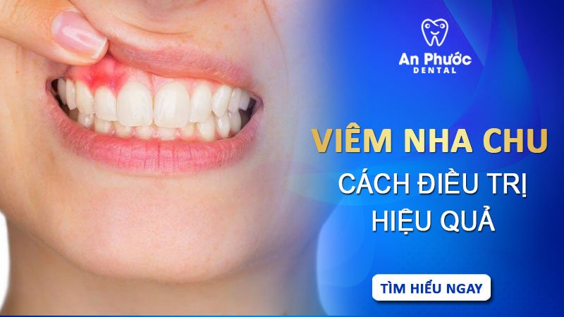 Điều trị viêm nha chu – Giải pháp bảo vệ sức khỏe răng miệng