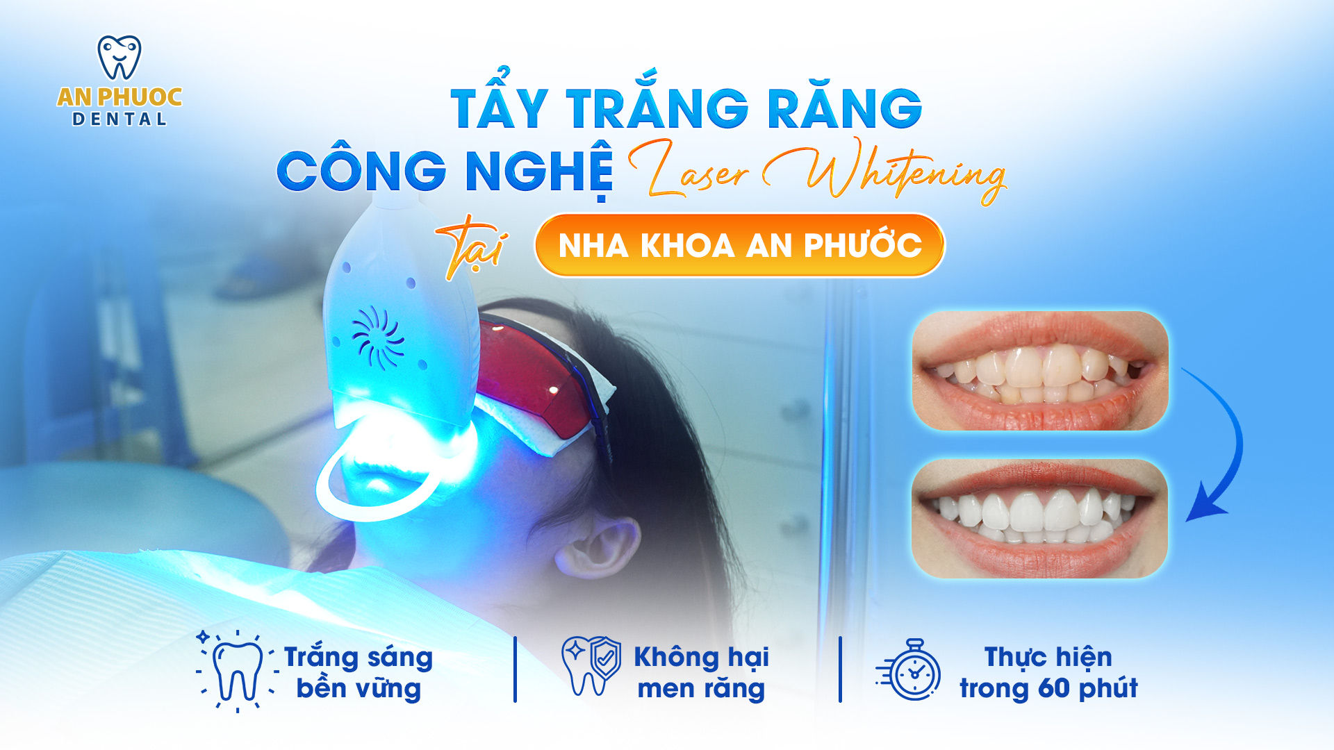 Tẩy trắng răng công nghệ Laser Whitening tại Long An giá bao nhiêu? Tẩy trắng răng công nghệ Laser Whitening tại Nha khoa An Phước