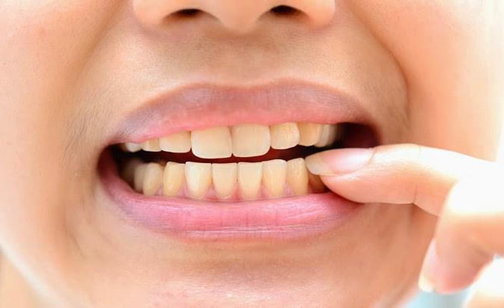 Tẩy trắng răng là phương pháp cải thiện màu răng phổ biến hiện nay