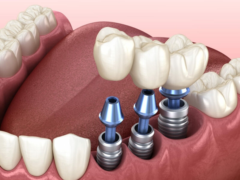 Cần lưu ý chăm sóc, vệ sinh răng miệng sau khi cấy ghép Implant
