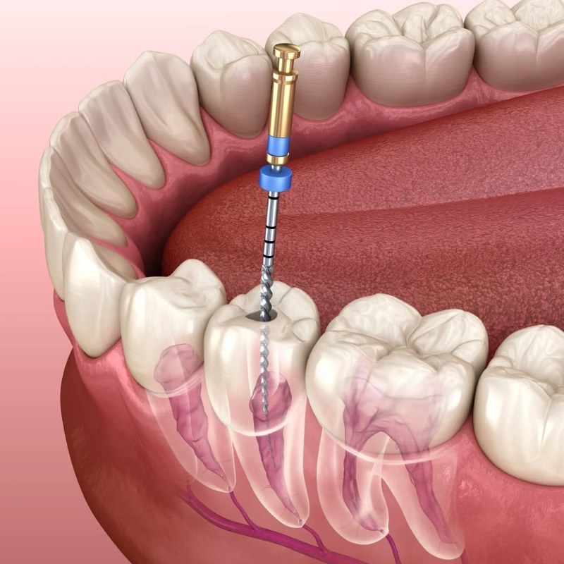 Khi nào cần điều trị viêm tủy răng?