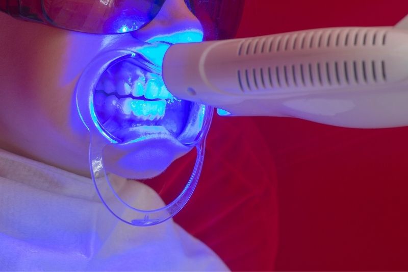 Tẩy trắng răng bằng công nghệ Laser Whitening mang hiệu quả nhanh chóng, trắng sáng bật tone rõ rệt ngay sau khi thực hiện
