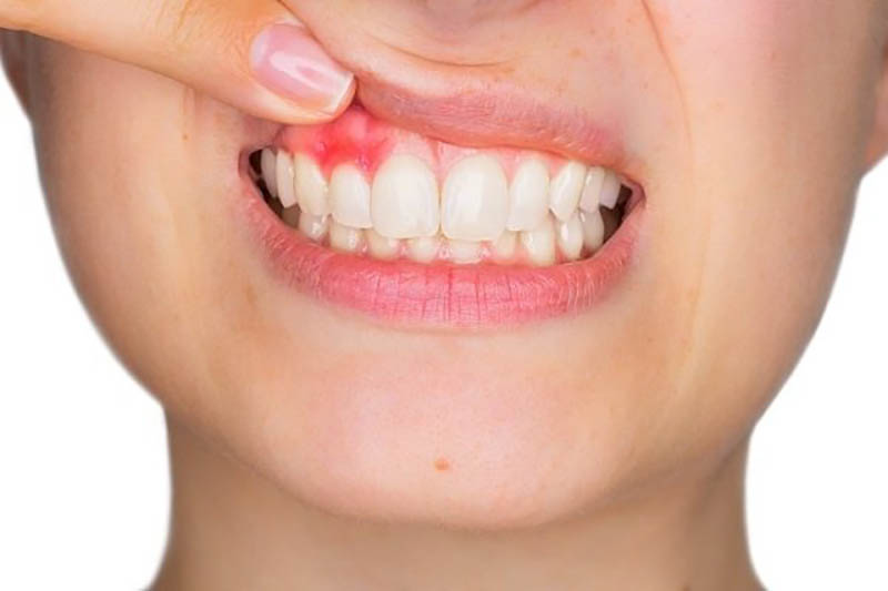 Vệ sinh răng miệng kém là nguyên nhân hàng đầu gây bệnh viêm nha chu