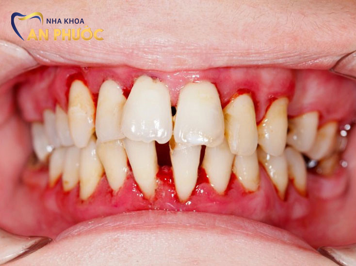 Viêm nha chu là một trong những bệnh răng miệng thường gặp với các dấu hiệu dễ nhận biết.