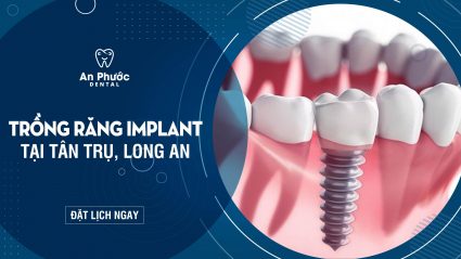 Trồng răng Implant ở đâu tại Tân Trụ, Long An chất lượng uy tín