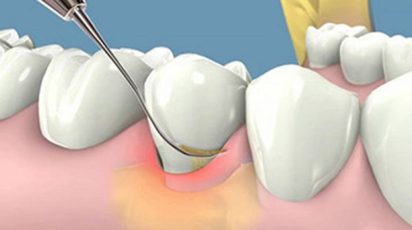 Cạo vôi răng giúp ngăn ngừa sâu răng và viêm nướu