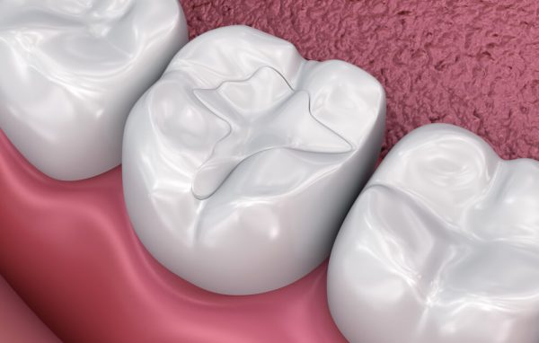 Trám răng giúp cải thiện tính thẩm mỹ