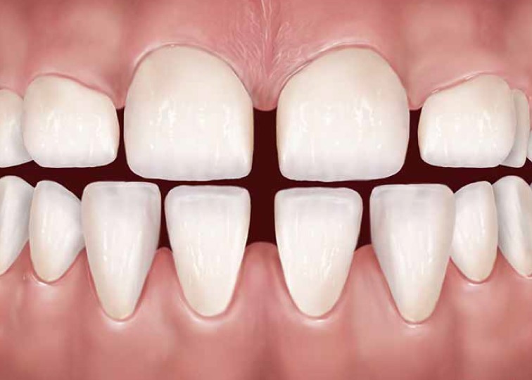 Nên trám hay bọc răng sứ? Phương pháp nào tốt hơn Răng thưa