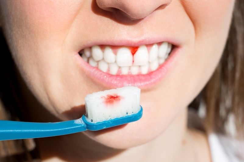 Những trường hợp nào không nên tẩy trắng răng? khong-nen-tay-trang-rang-khi-bi-benh-rang-mieng