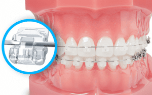 Khi niềng răng cần tránh những hoạt động gì?