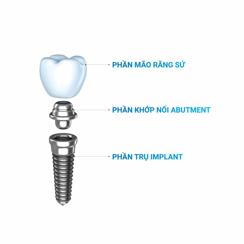 trồng răng bằng phương pháp implant