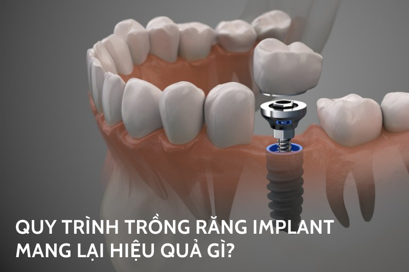 Quy trình trồng răng Implant mang lại hiệu quả gì?