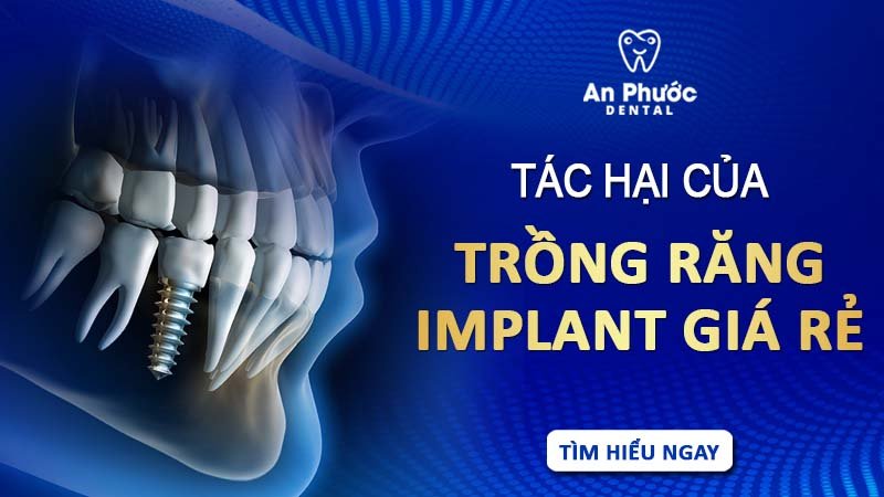 Tác hại khôn lường của trồng răng Implant giá rẻ