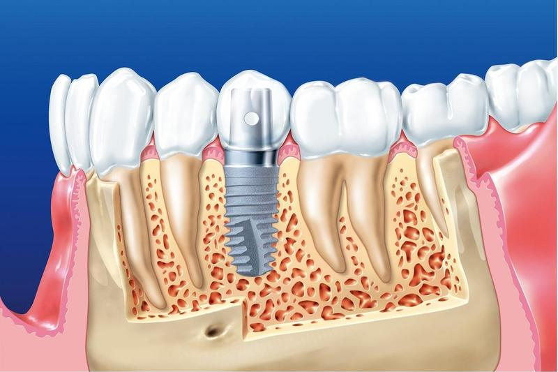 Cấy ghép Implant không ảnh hưởng răng lân cận