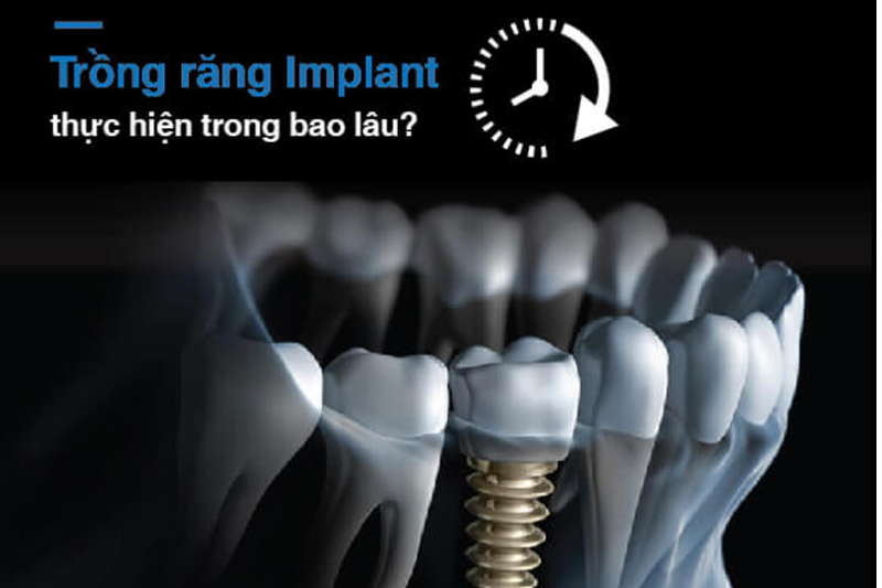 trồng răng implant bao lâu hoàn thành