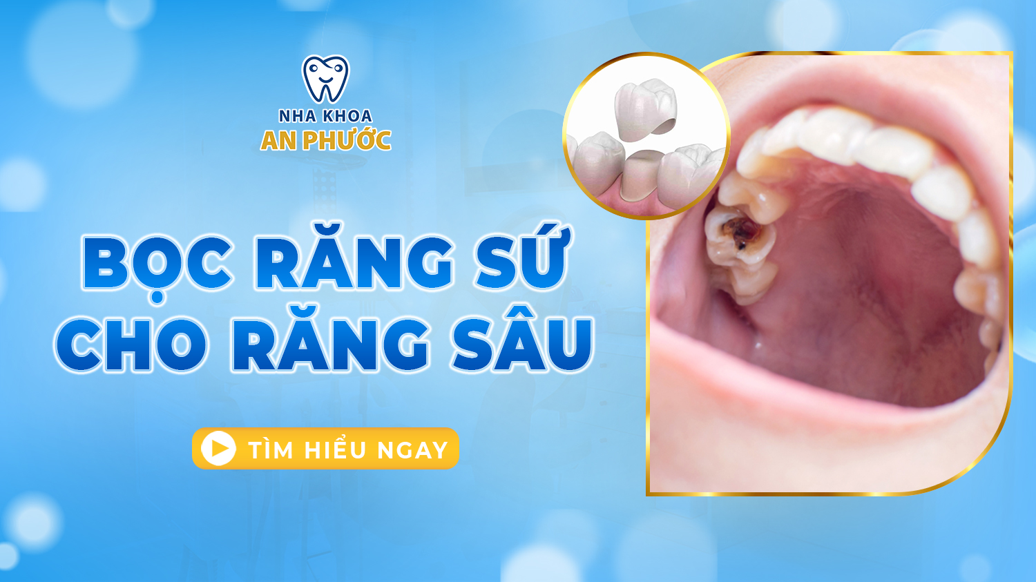 Bọc răng sứ cho răng sâu