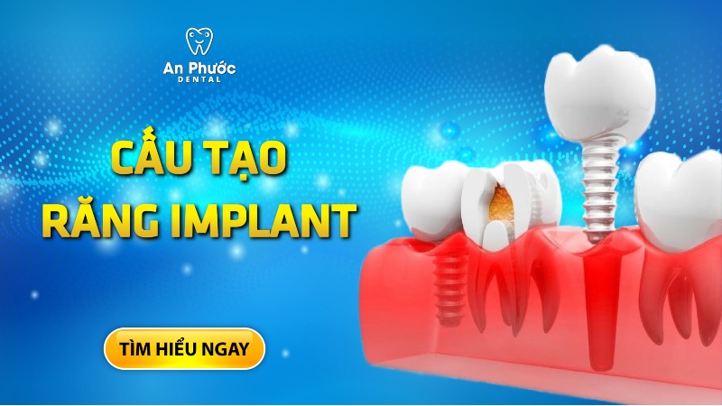 Răng Implant có cấu tạo như thế nào?