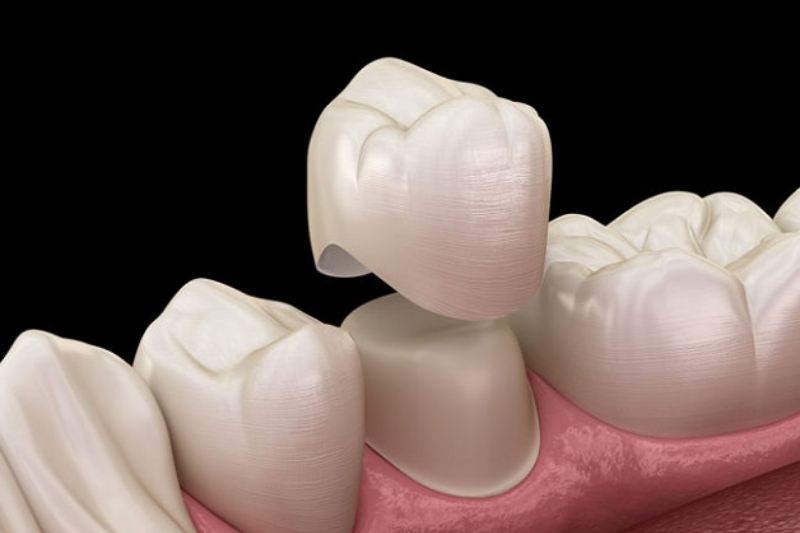 Bọc răng sứ giúp cải thiện thẩm mỹ răng