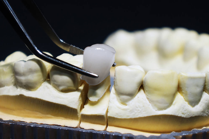 Chất liệu sứ ảnh hưởng đến độ bền của răng sứ