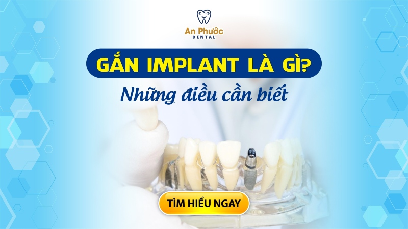 Gắn Implant là gì