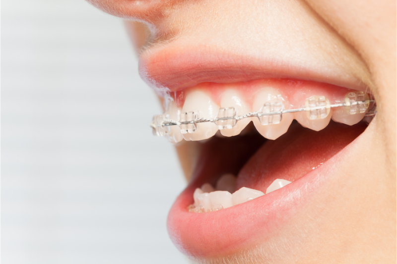 Niềng răng cố định là phương pháp chỉnh nha phổ biến hiện nay