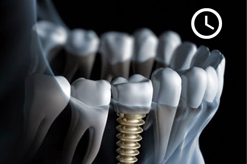 Thời gian gắn Implant phụ thuộc vào tình trạng răng của mỗi người