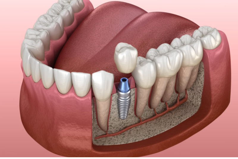 tru-implant-biotem-an-toan-voi-co-the