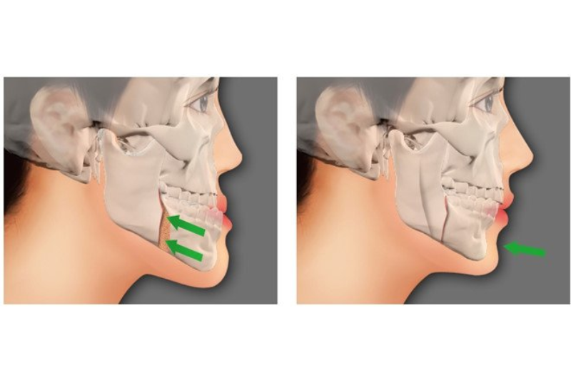 Móm do xương hàm cần phẫu thuật hàm