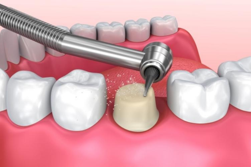 Mài răng bọc sứ có ảnh hưởng gì không?