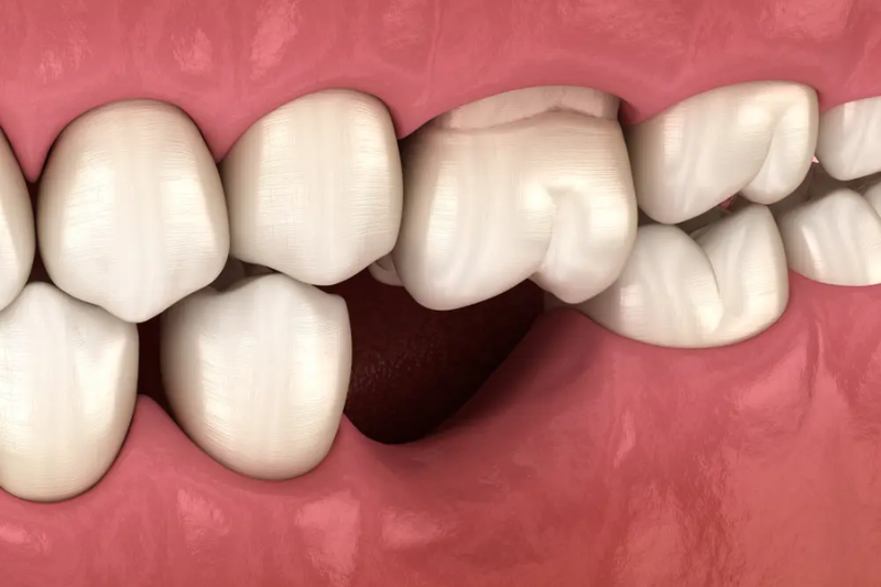 Mất răng dẫn đến tình trạng tiêu xương