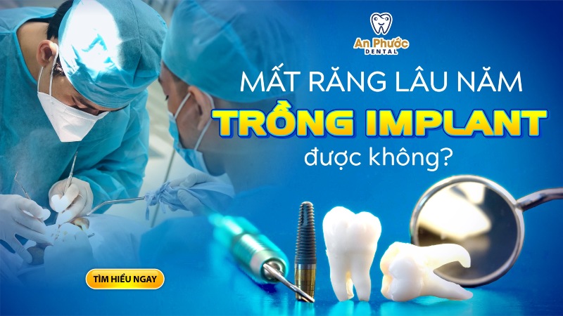 Mất răng lâu năm có trồng Implant được không? Mất răng lâu năm có trồng răng Implant được không