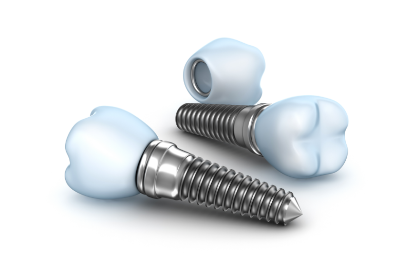 Trụ Implant được gắn với răng sứ thông qua khớp nối Abutment