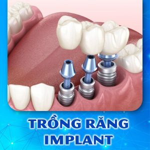 Dịch vụ_1_Trồng răng Implant