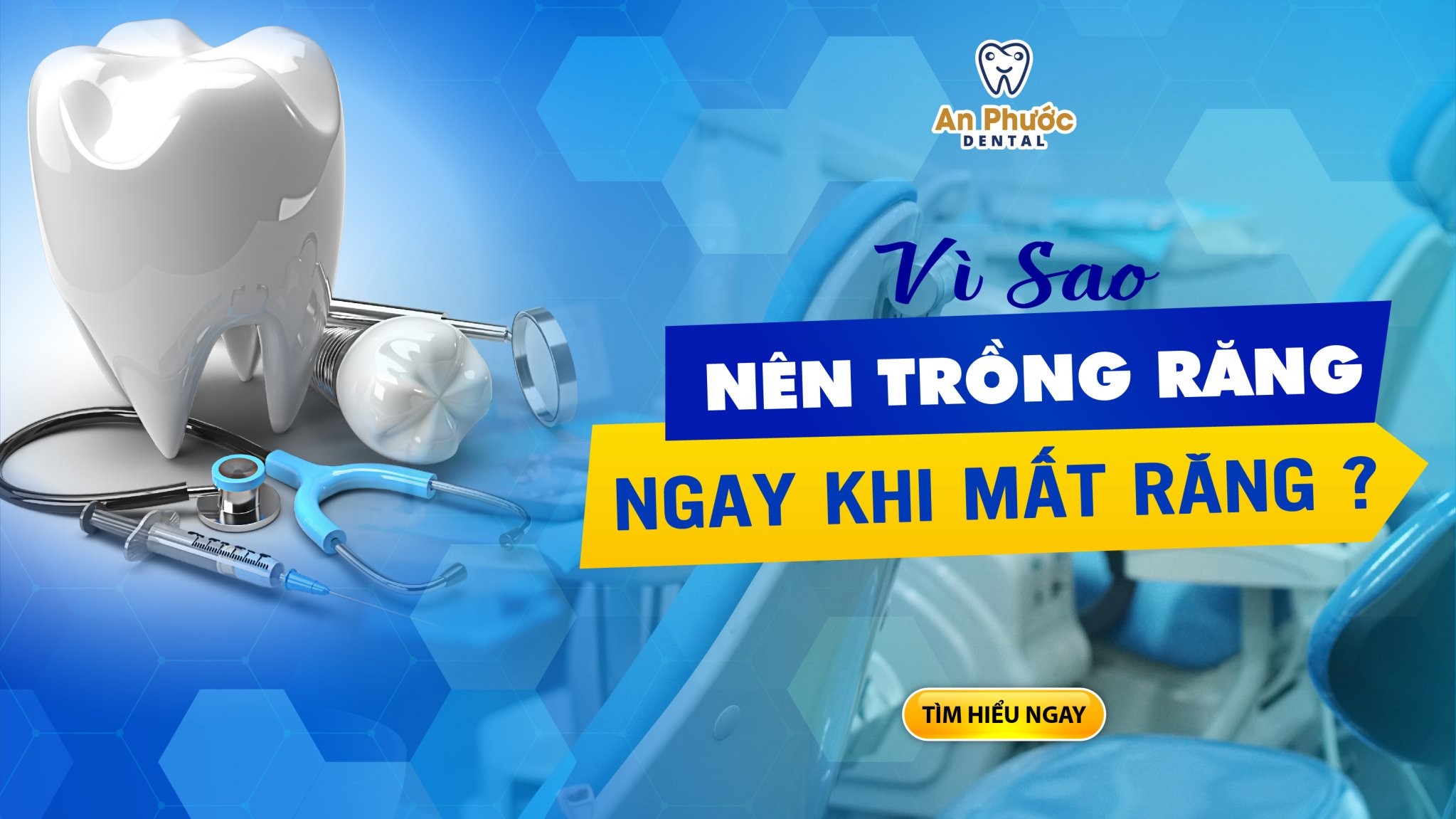 Lợi ích của việc trồng răng ngay khi mất răng mà bạn cần biết Vì sao nên trồng răng sau khi mất răng