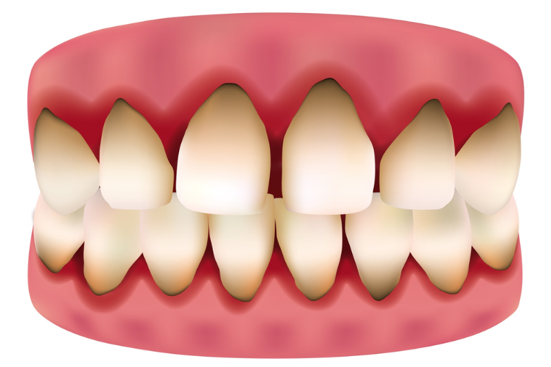 Dấu hiệu răng sứ bị hở là khi xuất hiện những vết đen quanh răng