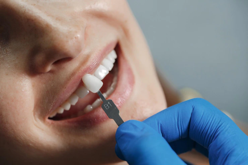 Bọc răng sứ mang lại tính thẩm mỹ cao được nhiều người quan tâm và ưa chuộng.