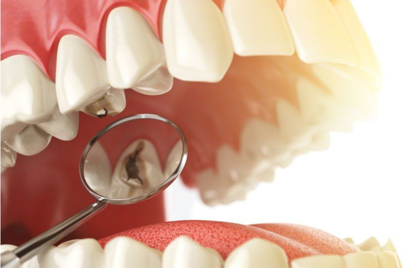 Răng sâu ở mức độ nặng cần xử lý nhiều bước mới có thể tiến hành niềng răng