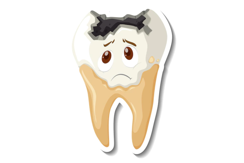 Tình trạng sâu răng nghiêm trọng