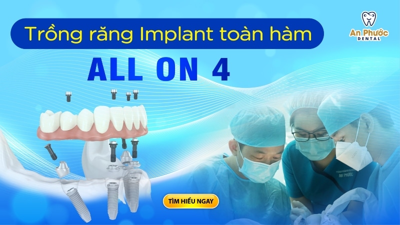 Trồng răng Implant toàn hàm All On 4 và những ưu điểm nổi trội
