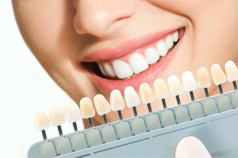 Bọc răng sứ bao lâu thì ăn được bình thường?