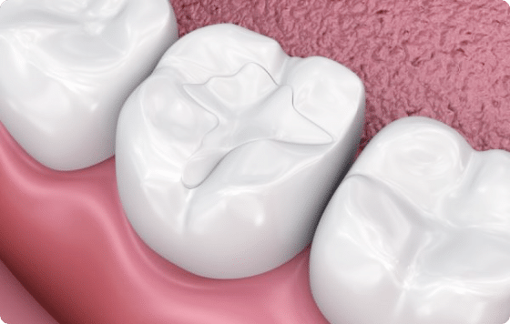 Trám răng thẩm mỹ – Khắc phục khuyết điểm răng nhanh chóng