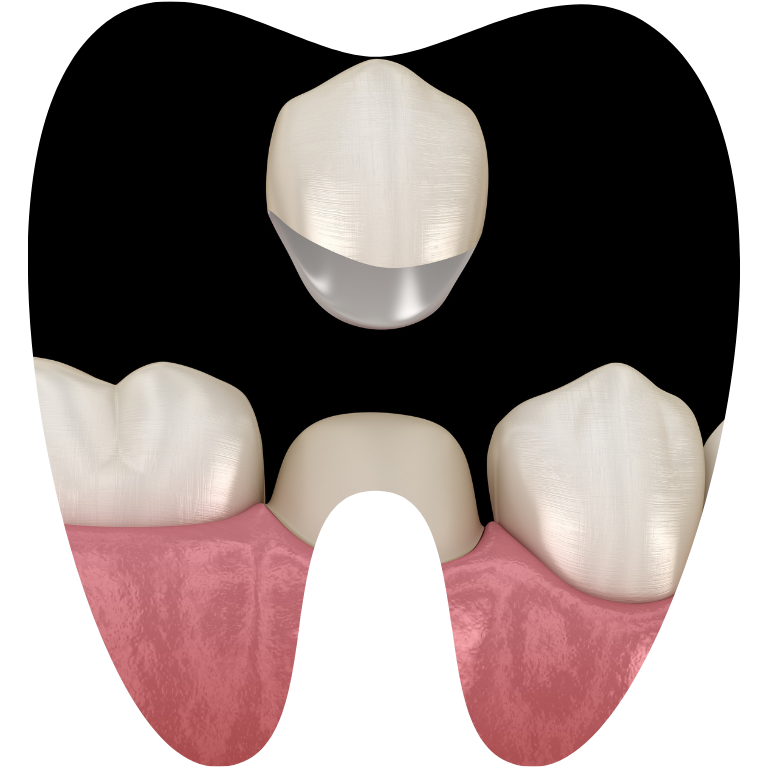 Boc rang su phuc hinh Tháng 4 15, 2026