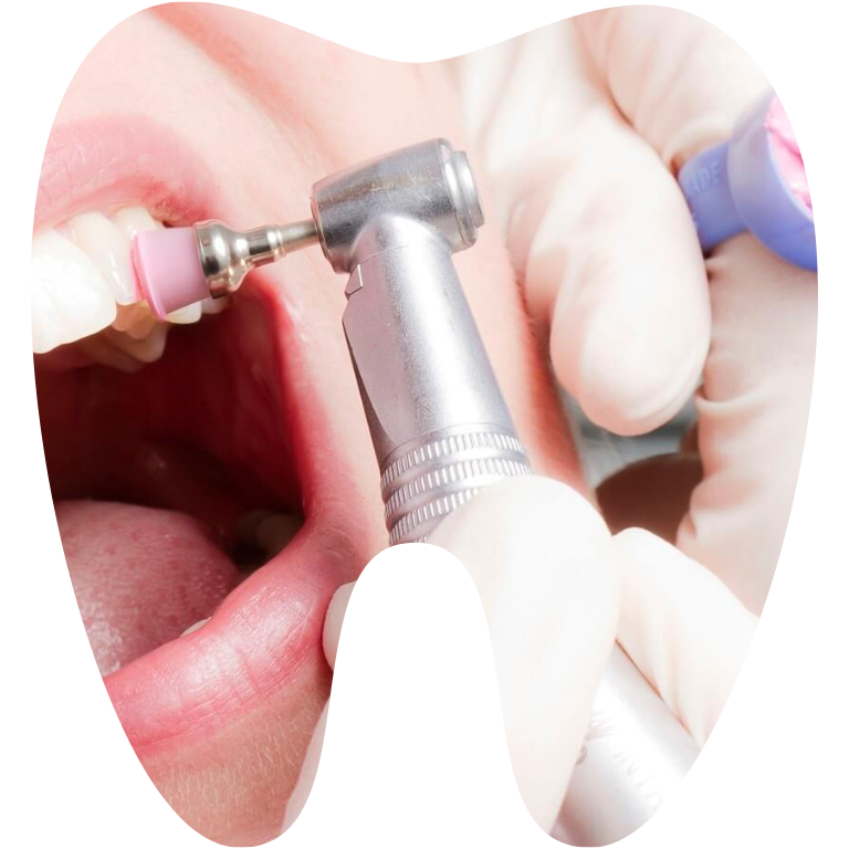 Danh bong be mat rang Tháng mười một 18, 2025